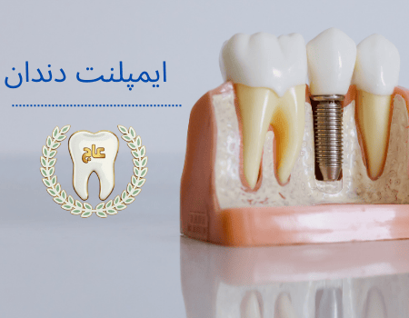 هزینه ایمپلنت دندان در فردیس